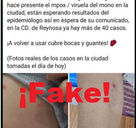 Reynosa, aún sin casos de mpox